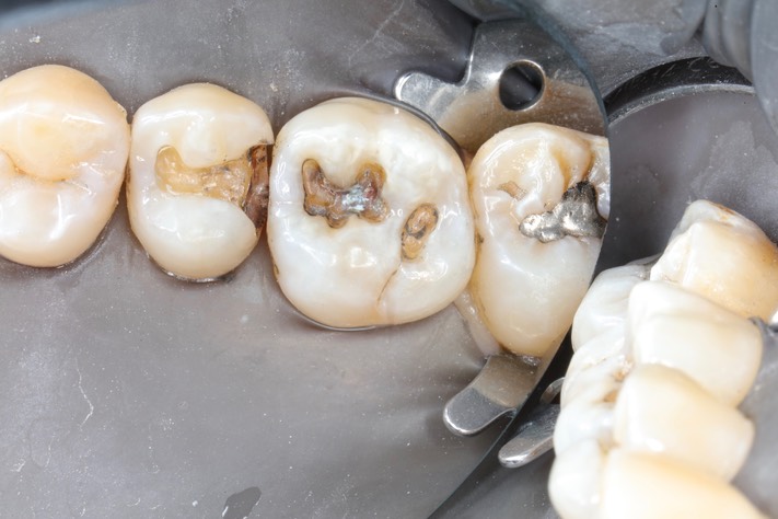 Matt Dodson #3-4 amalgam removal