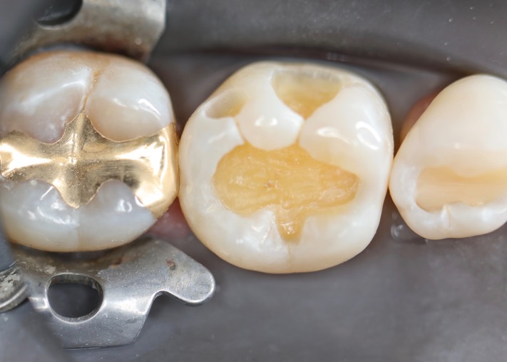 Matt Dodson #30 composite removal