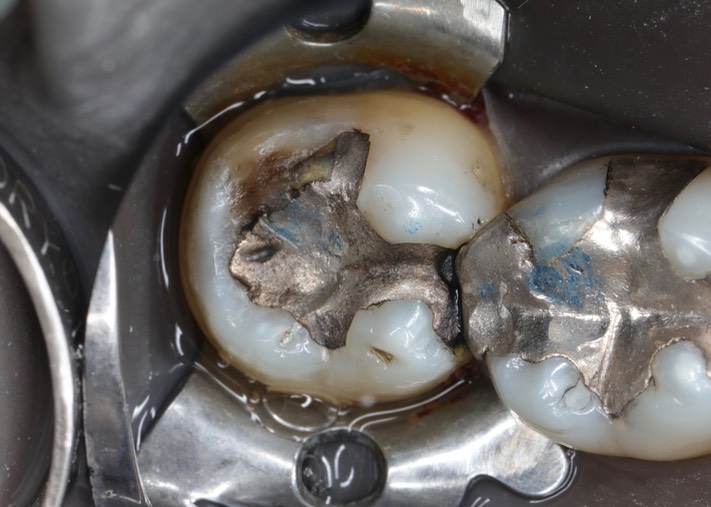 Matt Dodson #31 pre-op