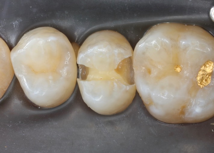 Matt Dodson #4 caries removal