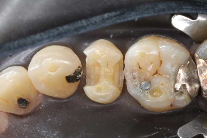 Matt Dodson #4 composite removal