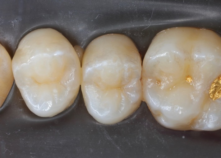 Matt Dodson #4 pre-op