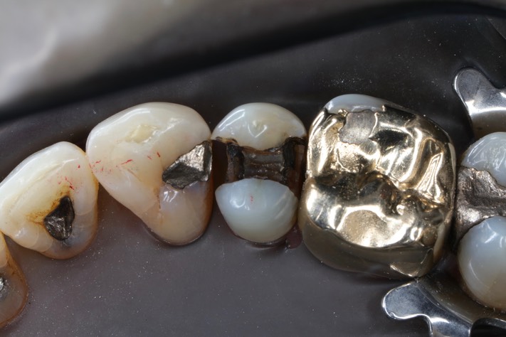 Matt Dodson #5 amalgam removal