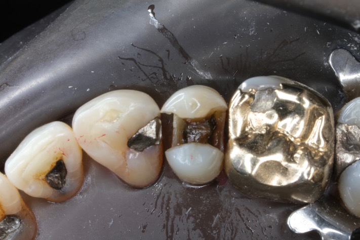 Matt Dodson #5 caries removal