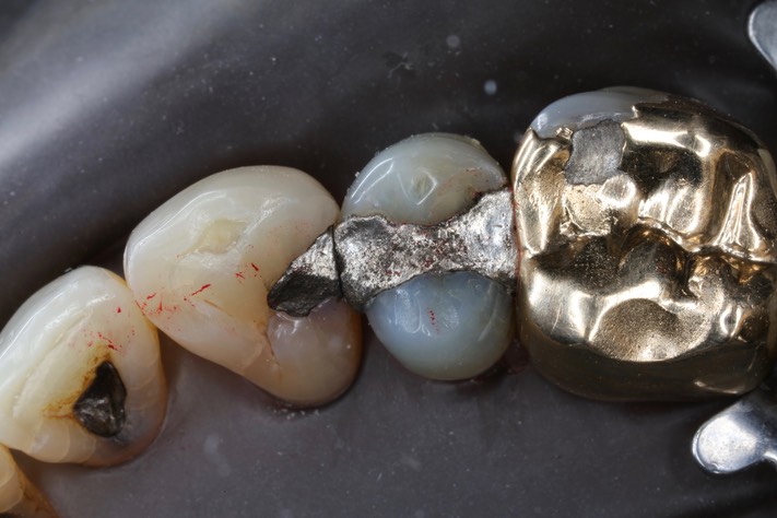 Matt Dodson #5 pre-op