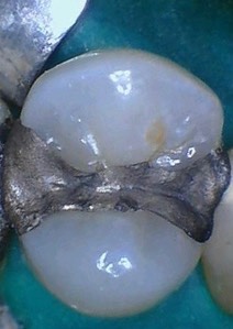 Mendel Sato #12 pre-op