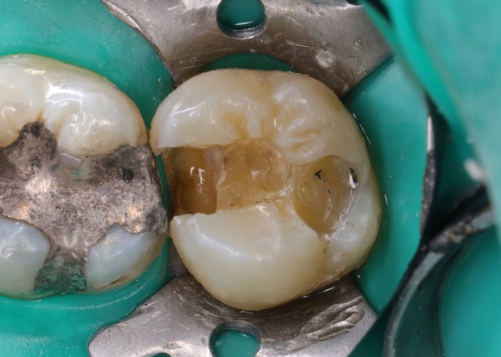 Mendel Sato #2 amalgam removal