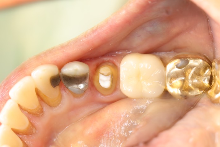 Mendel Sato #20 prep