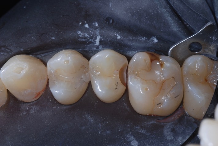 Nina Hayashi #4 composite removal