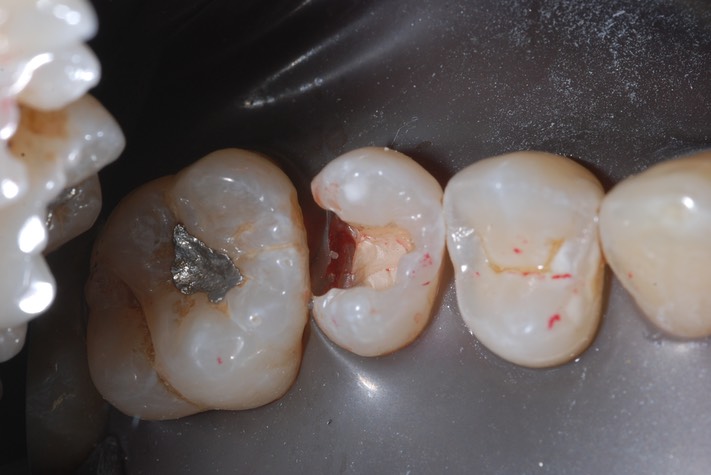 Roland Ylarde #13 amalgam removal