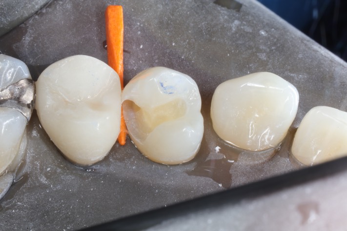 Scott Kanamori #12 caries removal