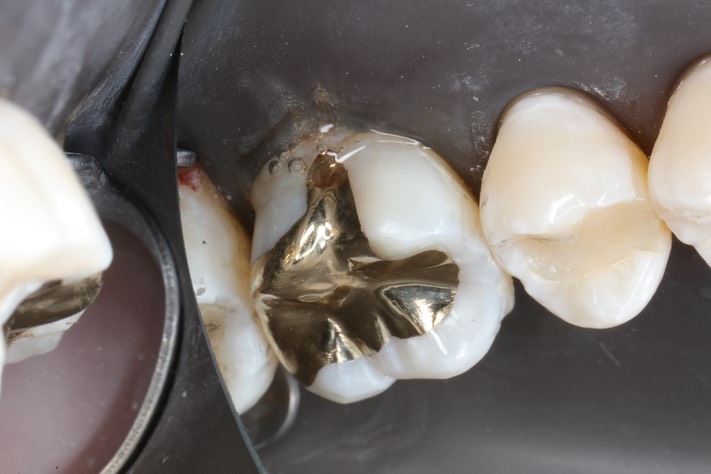 Scott Kanamori #14 buccal