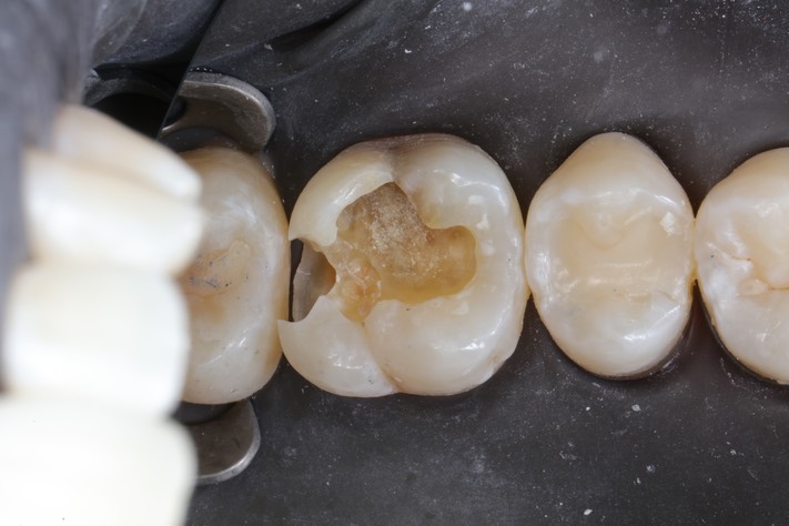 Scott Kanamori #14 caries removal