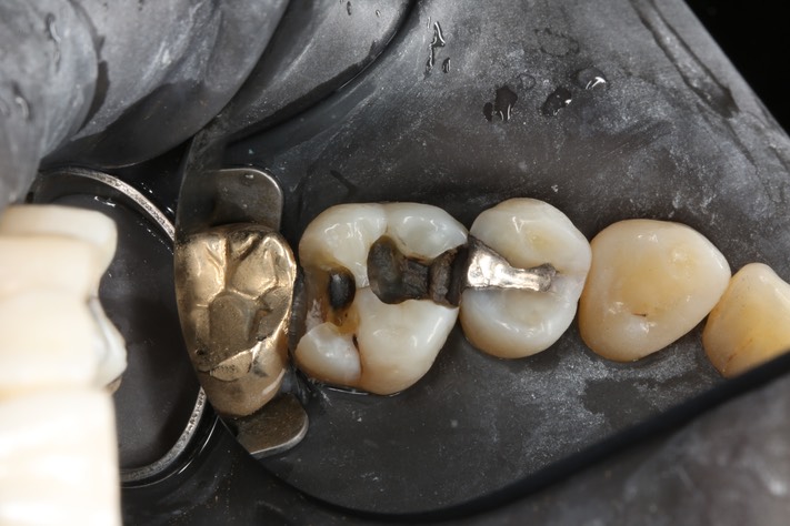 Scott Kanamori #14 caries removal