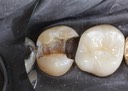 Scott Kanamori #15 caries removal