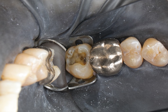 Scott Kanamori #15 composite removal