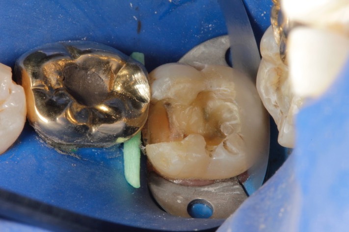 Scott Kanamori #18 amalgam removal