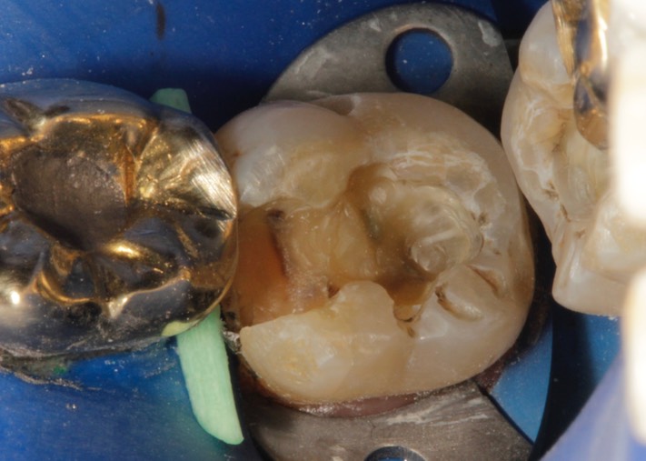 Scott Kanamori #18 amalgam removal 2