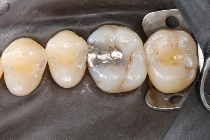 Scott Kanamori #3 pre-op with dam