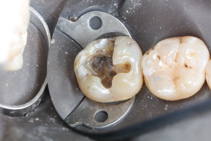 Scott Kanamori #31 amalgam removal