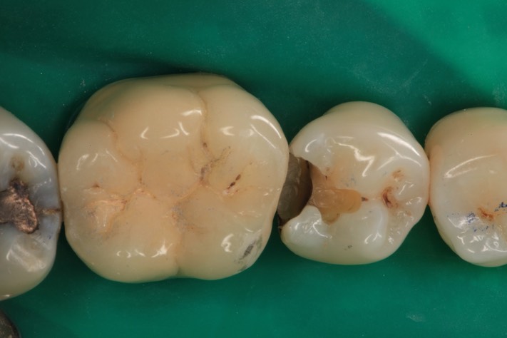 Scott Kanamori #29 amalgam removal