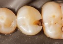Ted Dodson #20 amalgam removal