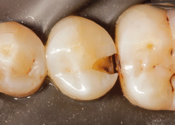 Ted Dodson #20 amalgam removal
