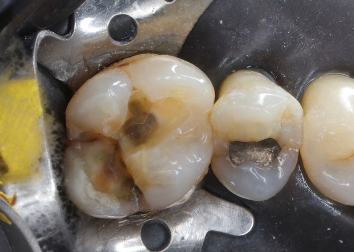 Ted Kanamori #14 amalgam removal