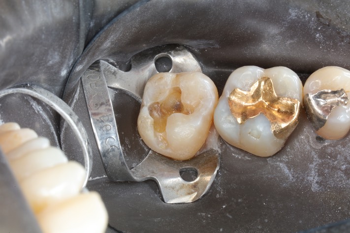 Ted Kanamori #15 composite removal