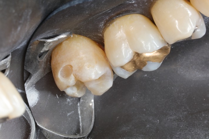 Ted Kanamori #15 composite removal