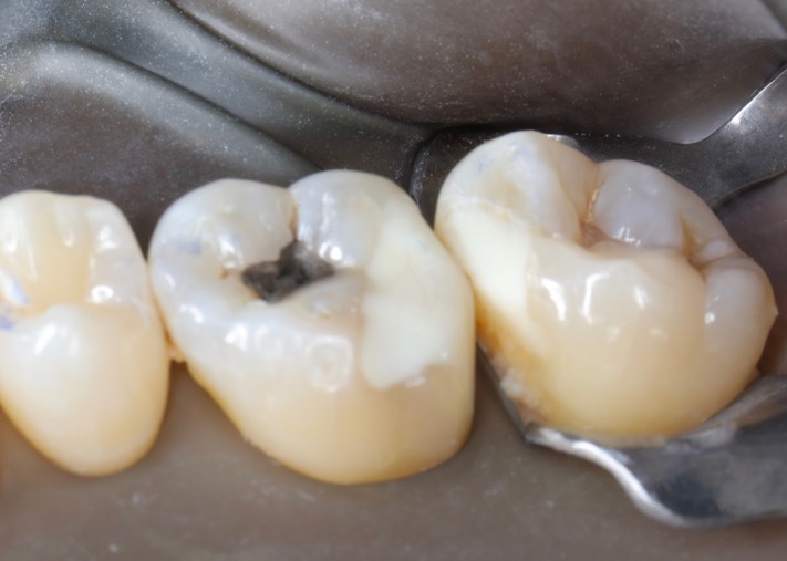 Ted Kanamori #2-3 lingual view - fracture lines