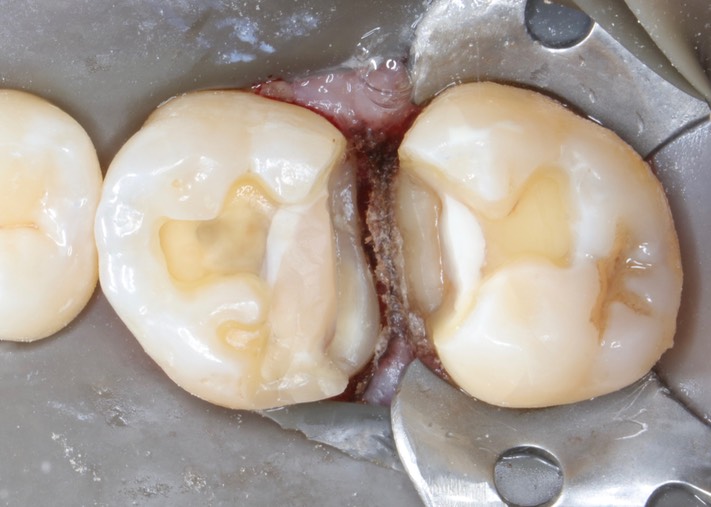 Ted Kanamori #2-3 prep