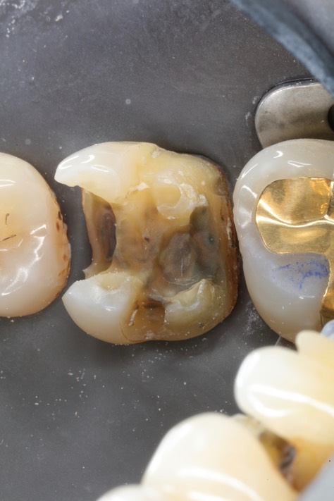 Ted Kanamori #3 crown removal