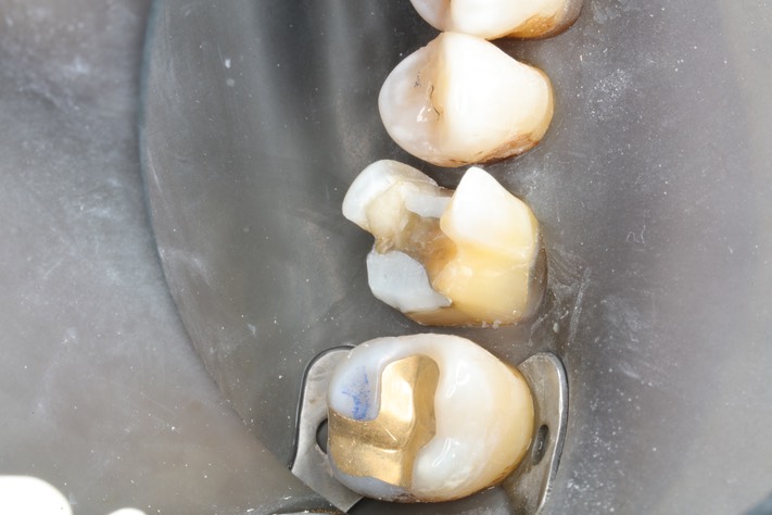 Ted Kanamori #3 prep - buccal