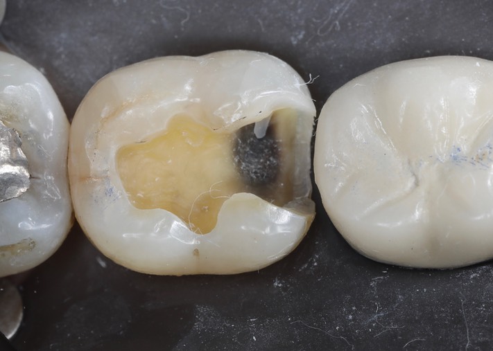 Ted Kanamori #31 caries removal