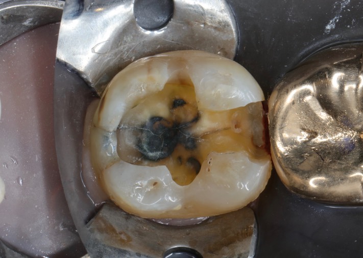 Ted Kanamori #31 caries removal