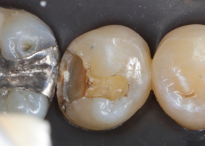 Ted Kanamori #29 caries removal