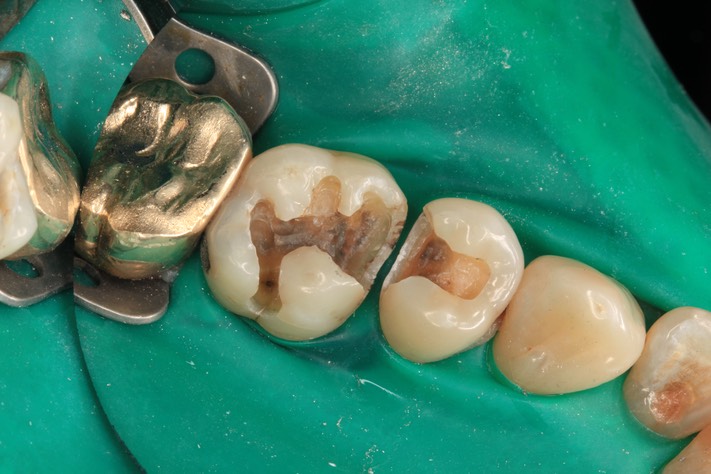 Ted Kanamori #13-14 caries removal