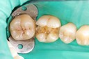 Wayne Chin #30 amalgam removal