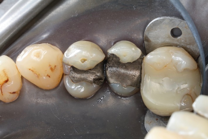 Wayne Chin #4-5 pre-op