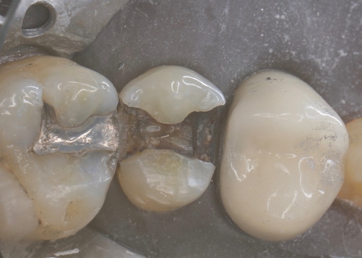 Wes Sato #13 amalgam removal