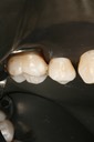 Wes Sato #4 finish - buccal  view